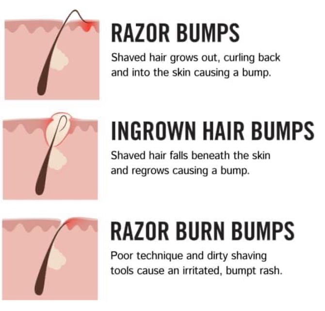 Razor Bumps & Ingrown Hairs